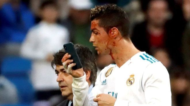 وہ لمحہ جب رونالڈو نے میدان میں موبائل پر اپنا زخمی چہرہ دیکھا