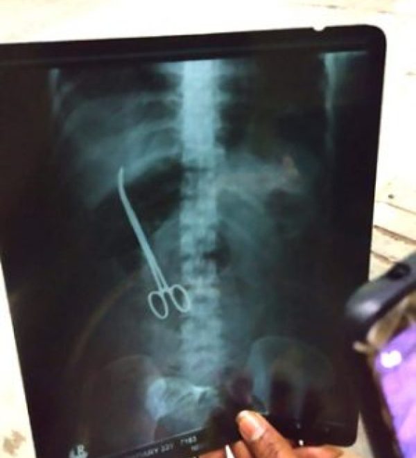 حیدرآباد : سرجری کے بعد سرجن نے خاتون کے پیٹ میں قینچی بھول گئے