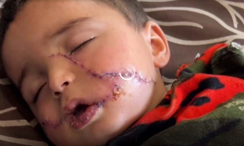 اسرائیلی بمباری میں ننھا بچہ زخمی، علاج کے دوران چہرے پر 200 ٹانکے لگے